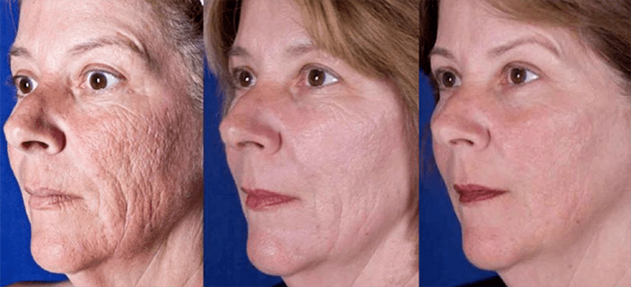 Efekt po zabiegu laserowego odmładzania skóry twarzy