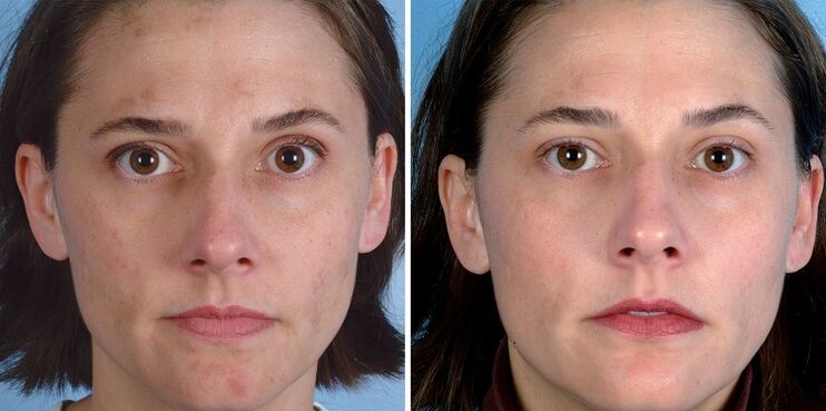 przed i po odmładzaniu skóry urządzeniem