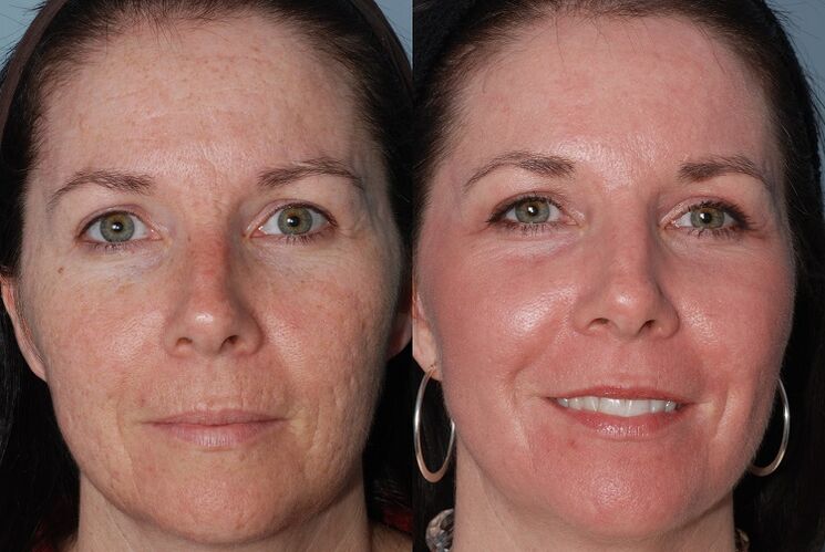 przed i po sprzętowym odmładzaniu skóry