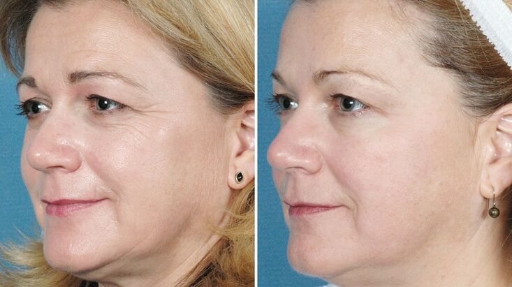 zdjęcia przed i po sprzętowym odmładzaniu skóry