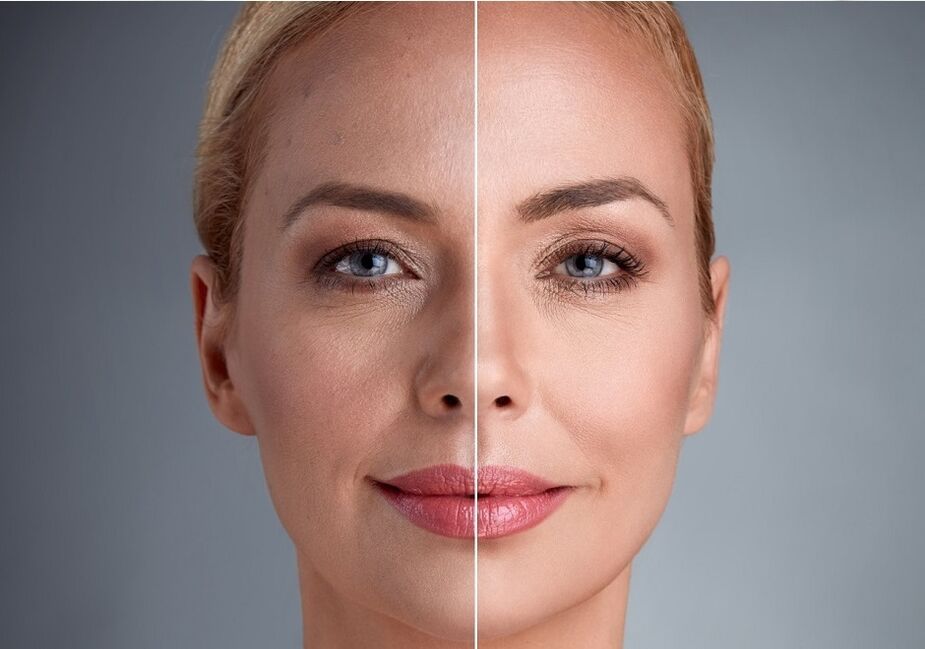 przed i po laserowym odmładzaniu twarzy