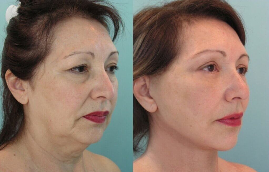 zdjęcie przed i po odmłodzeniu skóry